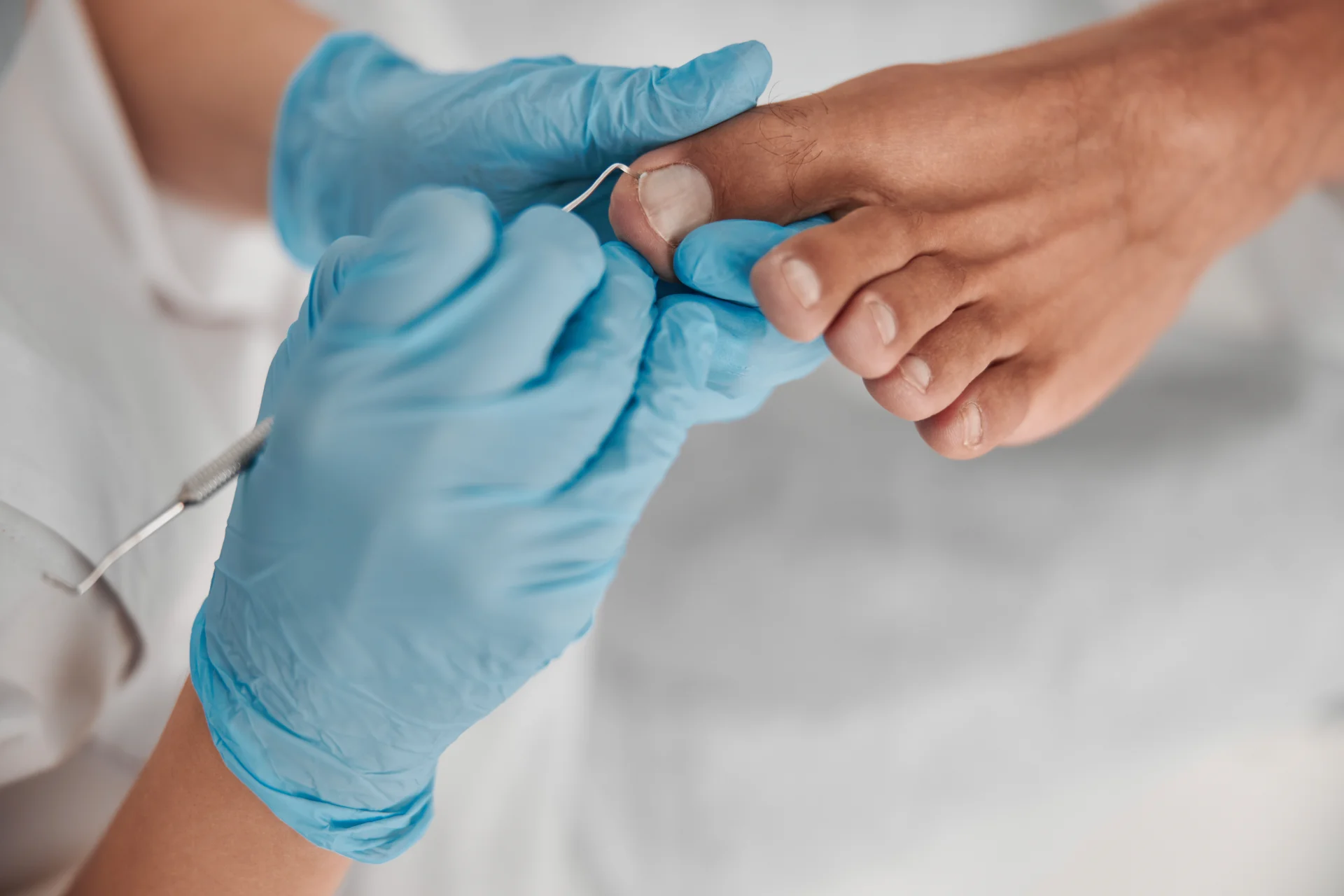 Home 13 Fungal-Nail-Infection