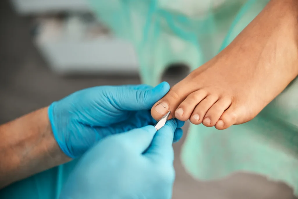 Ingrowing Toenails