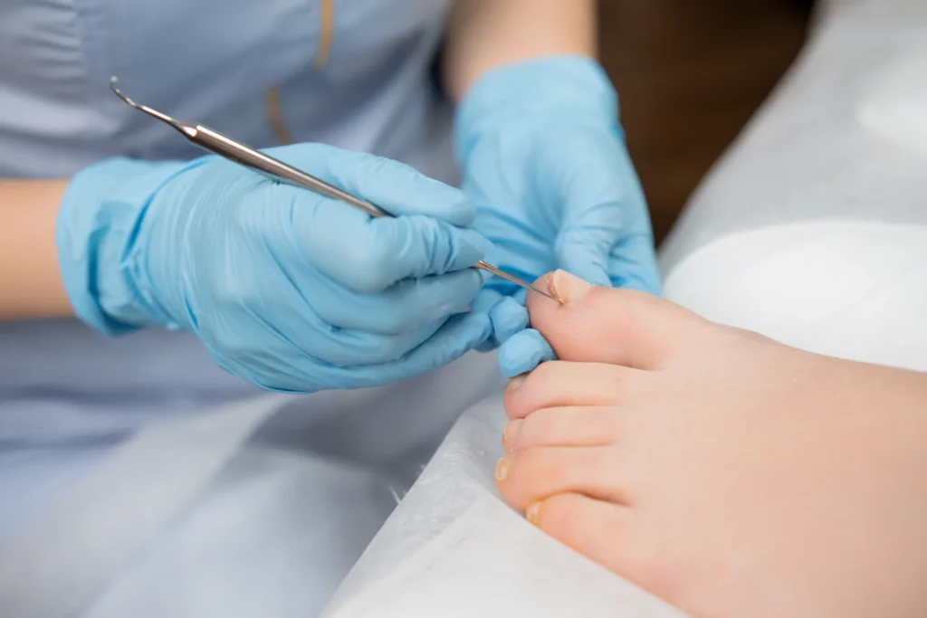 Nail Surgery