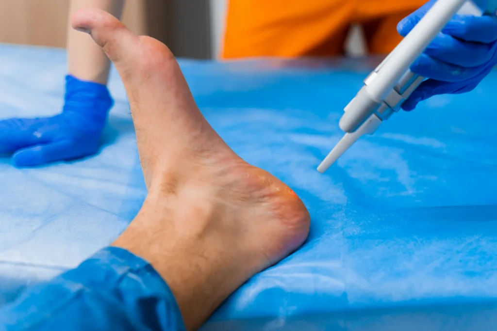 Verruca Treatment